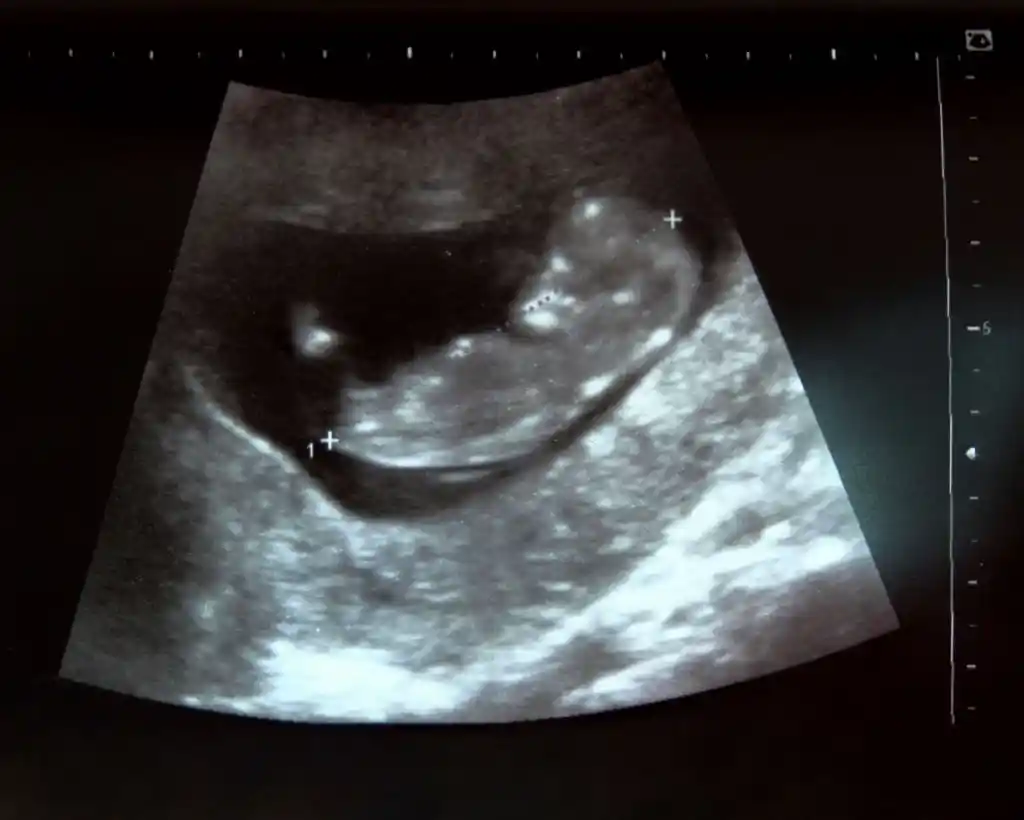 2d ultrasound baton rouge louisiana