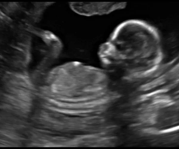 look at me 3d 4d ultrasound livingston louisiana 10