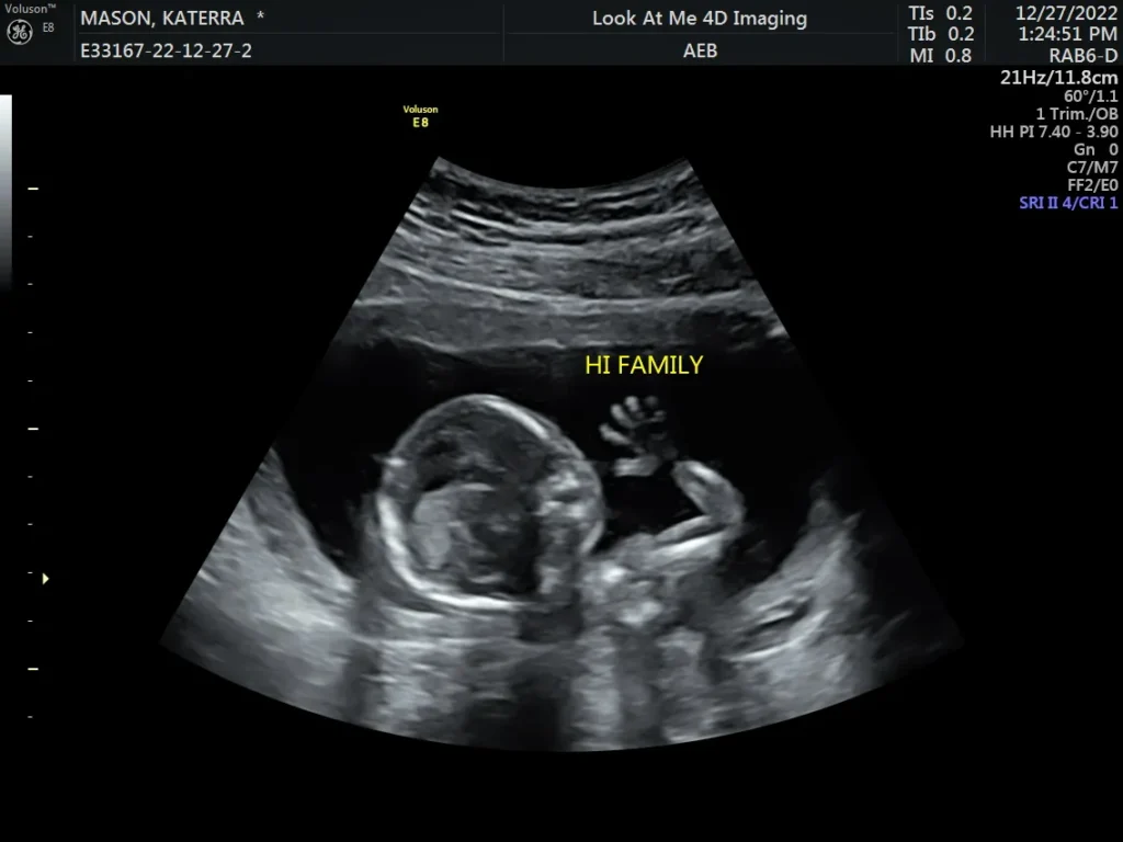 look at me 4d imaging 3d ultrasound screenshot 16