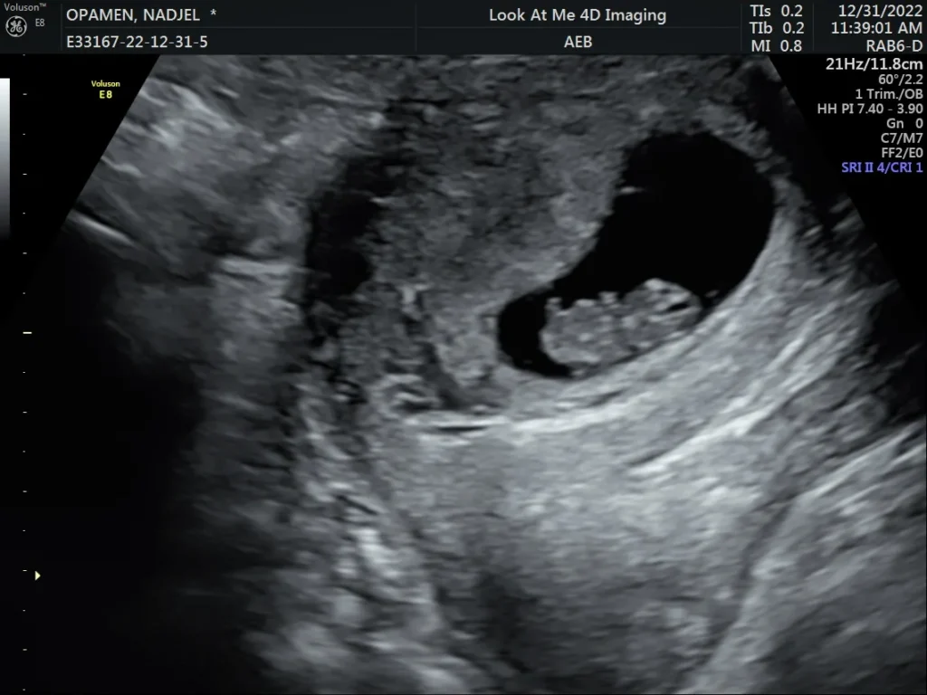 look at me 4d imaging 3d ultrasound screenshot 18